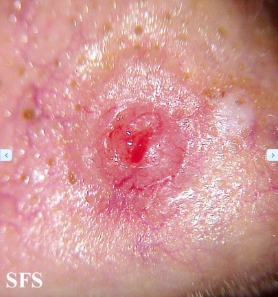 Understanding the Connection Between Rosacea and Warts